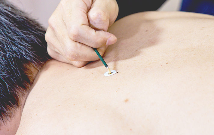 鍼灸施術イメージ