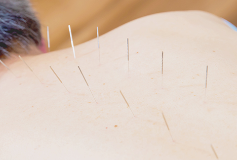 鍼灸施術画像