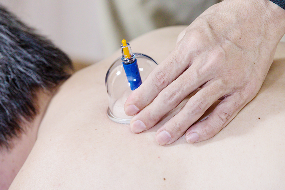 吸い玉施術画像