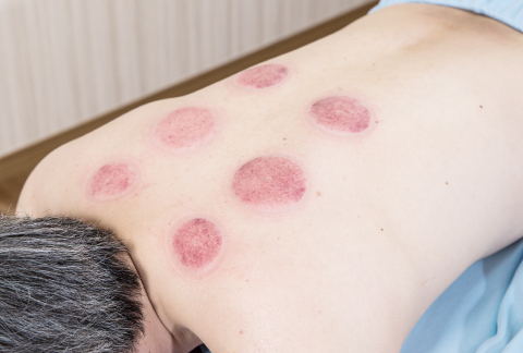 吸い玉施術画像